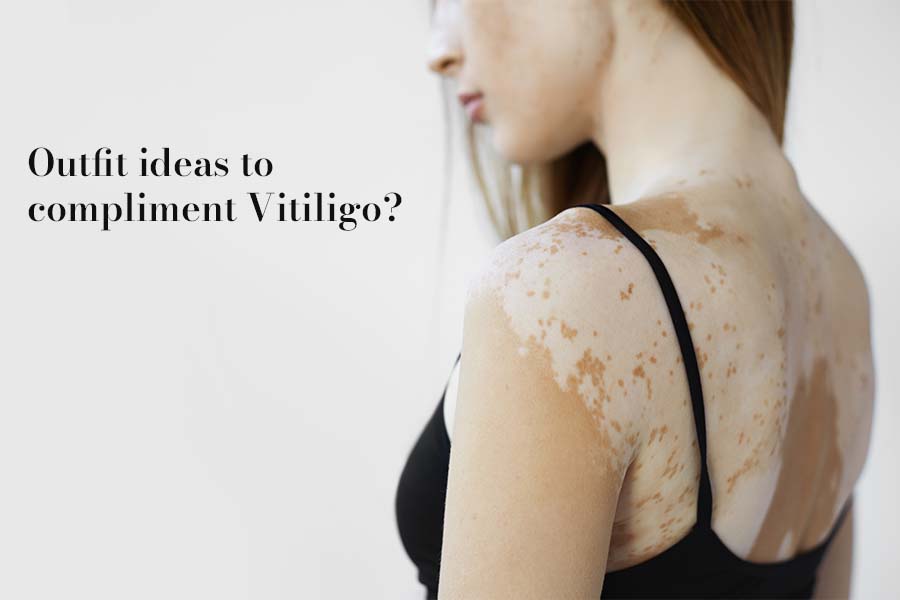 Outfit Ideas To Complement Vitiligo